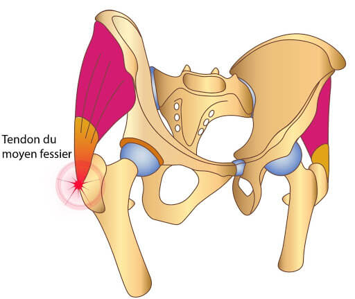 La Péri-Trochantérite - Comment soigner cette fausse douleur de hanche